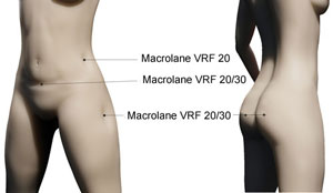 Macrolane Indications