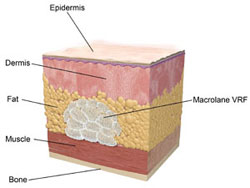 Macrolane Injection