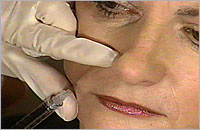 Dermal Filler Injection