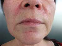 1 week after treatment with CRM dermal fillers