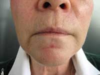 3 months after treatment with CRM dermal fillers