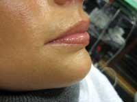 3 months after treatment with CRM dermal fillers