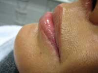 6 months after treatment with CRM dermal fillers