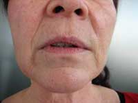 Before treatment with CRM dermal fillers