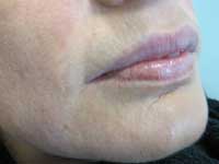 Before treatment with CRM dermal fillers