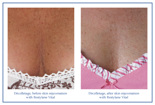 Before & After Decolletage with Restylane Vital