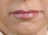 Lips after  treatment with Hydrafill