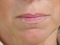 Lips before treatment with Hydrafill