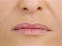 Nasolabial lines  after treatment with Hydrafill
