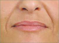 Nasolabial lines before treatment