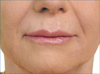 Nasolabial and  manrionette lines after treatment with Hydrafill