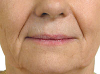 Nasolabial and  manrionette lines before treatment with Hydrafill