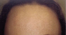Forehead after Botox Injections