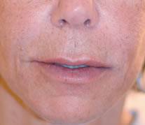 After treatment with Teosyal