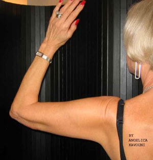 Post Upper Arm Lift Surgery