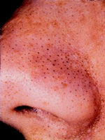 Before Comedone Removal With Microdermabrasion