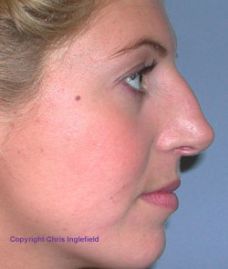 rhinoplasty