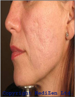Acne Scarring