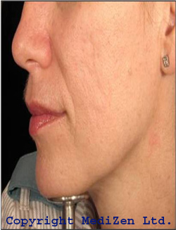 After Treatment with VAVELTA