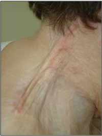 Skin Contracture after burns