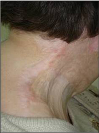 Reduction in contracture after treatment with VAVELTA