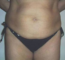 Female before Eporex no-needle mesotherapy treatment