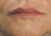 Improvement in lip shape and lip lines lines after treatment with Restylane®