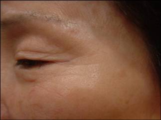 Crow's Feet After Treatment with MTS Roller