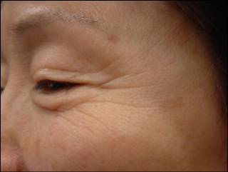 Crow's Feet Before Treatment