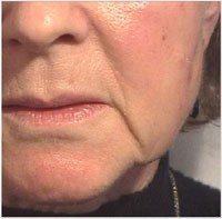 Nasolabial folds and oral commissures before treatment with Juvederm®