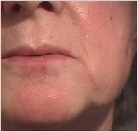 Nasolabial folds and oral commissures after treatment with Juvederm® 30
