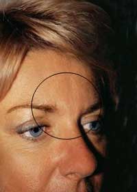 Glabellar frown lines after treatment with Isolagen�.