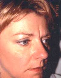 Glabellar frown lines before treatment with Isolagen�.