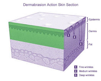 Dermabrasion Action Skin Section