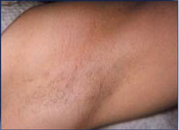 Reduction in underarm hair following a course of 2 IPL treatments over 4 months.