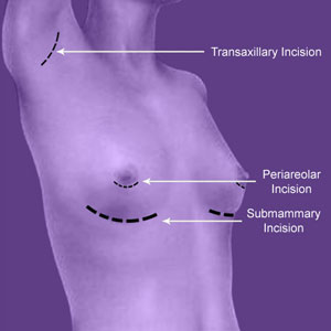 Breast Implant Insertion Points
