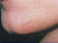 Reduction in facial hair following a course of 3 IPL treatments over 6 months