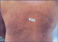 Male with hair on the back before treatment.