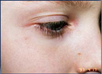 Patient 1 month after 1 IPL 