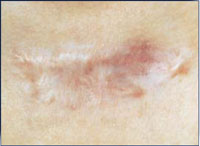 Patient after 8 IPL treatments.