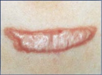 33 year old female with keloid scar on her chest.