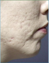 Acne Sacrring After Microdermabrasion
