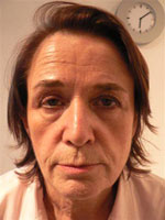 Before Evolence Treatment