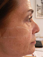 Before Evolence Treatment - Mid face volume loss.