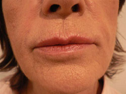 After Evolence Breeze Treatment