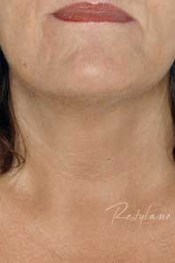 Neck after treatment with RESTYLANE� Vital hspace=