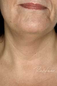 Neck before treatment with RESTYLANE� Vital