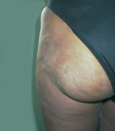 Posterior after injection of Bio-Alcamid™