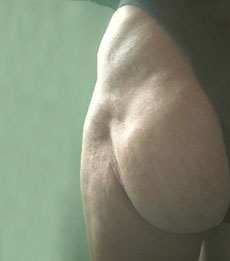 Posterior before treatment with Bio-Alcamid™