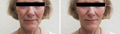 Virtual Surgery Mid-Face Lift